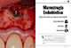 Microcirugía Endodóntica Ante una lesión periapical persistente